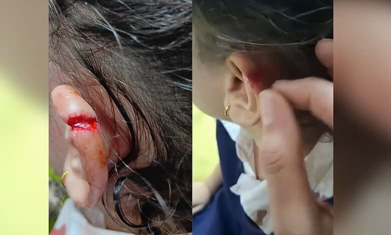 Uma estudante de 4 anos ficou ferida após ser agredida por um professor