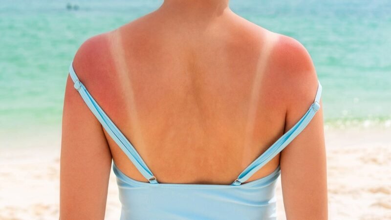 A tendência ‘Tanamaxxing’, que promove maior exposição solar, preocupa os dermatologistas